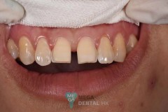 Emax veneer Images