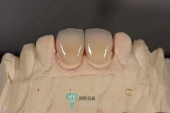 emax-veneer-1121-anterior-teeth-1