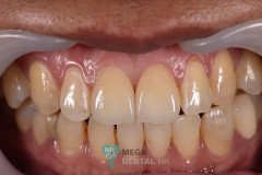 emax-veneer-1121-anterior-teeth-2