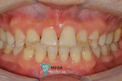 emax-veneers-Mega-dental-0