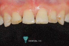 emax-veneers-Mega-dental-1