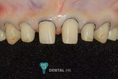 emax-veneers-Mega-dental-2
