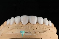 emax-veneers-Mega-dental-3