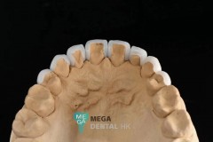 emax-veneers-Mega-dental-4