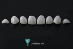 emax-veneers-Mega-dental-5