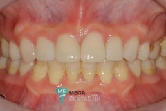 emax-veneers-Mega-dental-7