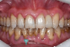 Full Ceramic Maryland