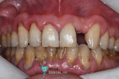 Full-Ceramic-Maryland-Bridge-MegaDental-1