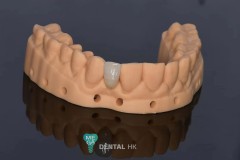 Full-Ceramic-Maryland-Bridge-MegaDental-2