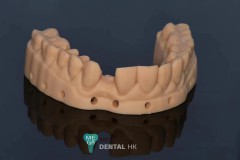 Full-Ceramic-Maryland-Bridge-MegaDental-3