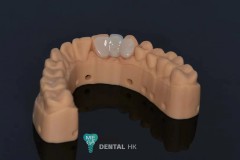 Full-Ceramic-Maryland-Bridge-MegaDental-4