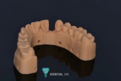 Full-Ceramic-Maryland-Bridge-MegaDental-5