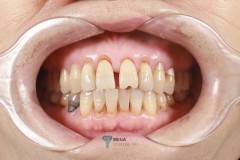 Glass Ceramic Crowns  Images