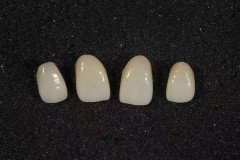 Mega-Dental-Glass-ceramic-crowns-case-2
