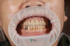 Mega-Dental-Glass-ceramic-crowns-case-3