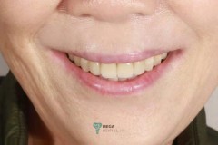 Mega-Dental-Glass-ceramic-crowns-case-4