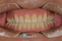 Implant Over Denture