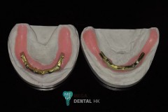Implant-over-denture-mega-dental-2