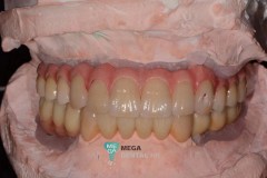 Malo Ti Bridge with Zirconia Crowns Images