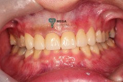 Full-Zirconia-Monolithic-Zirconia-2