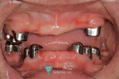 Telescopic Crowns with Dentures Images