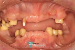 telescopic-crowns-with-dentures-1