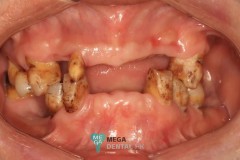 telescopic-crowns-with-dentures-2