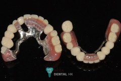 telescopic-crowns-with-dentures-3