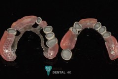 telescopic-crowns-with-dentures-4