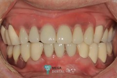 telescopic-crowns-with-dentures-6